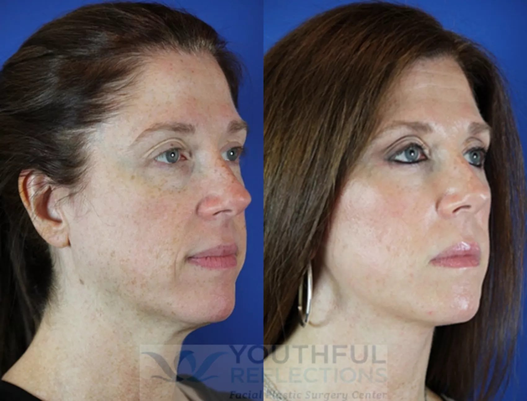 Level 1 Reflection Lift Before and After Photos