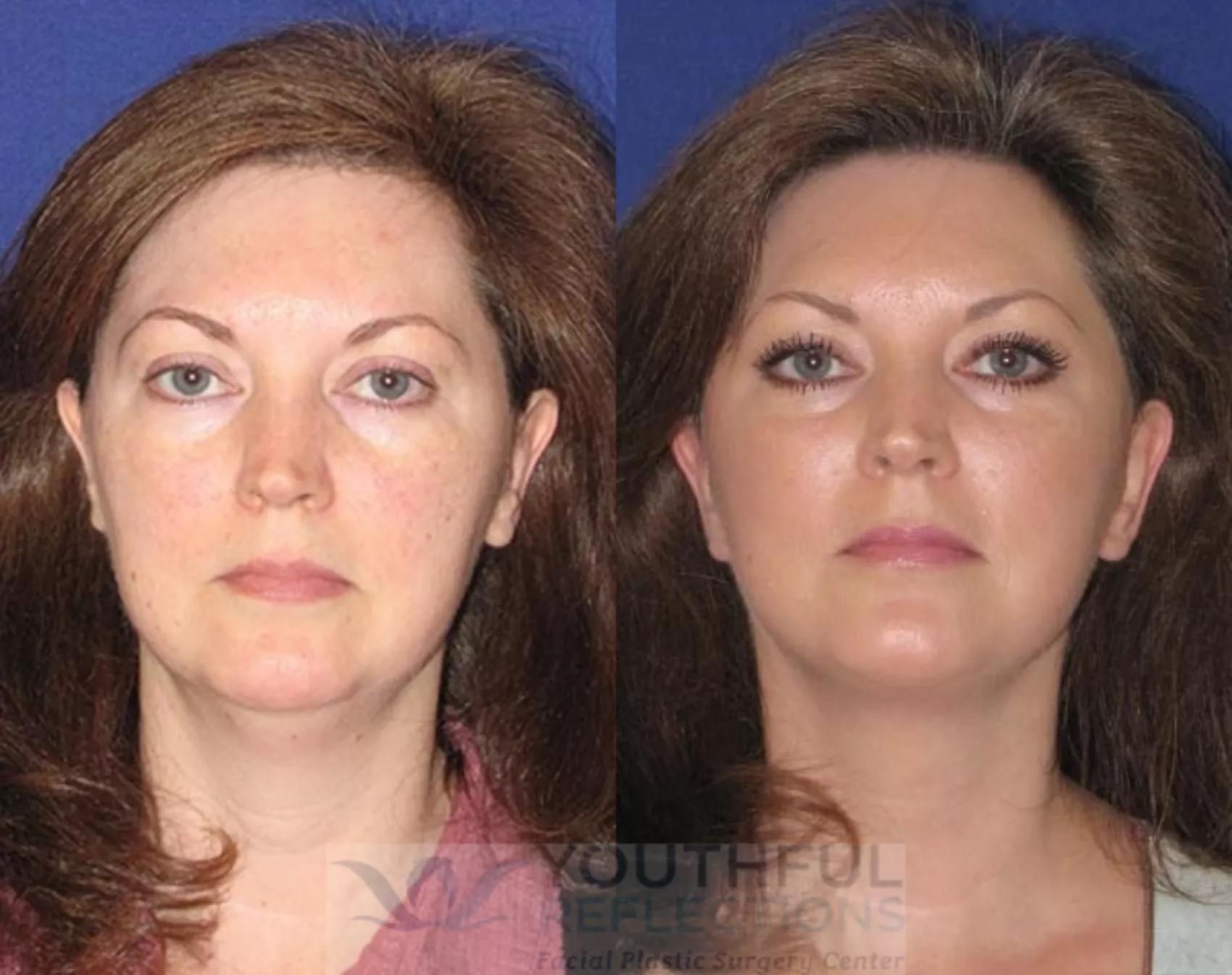 Level 2 Reflection Lift Before and After Photos