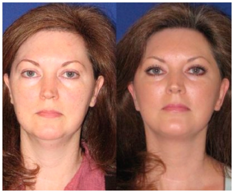 Level 2 Reflection Lift Before and After Photos