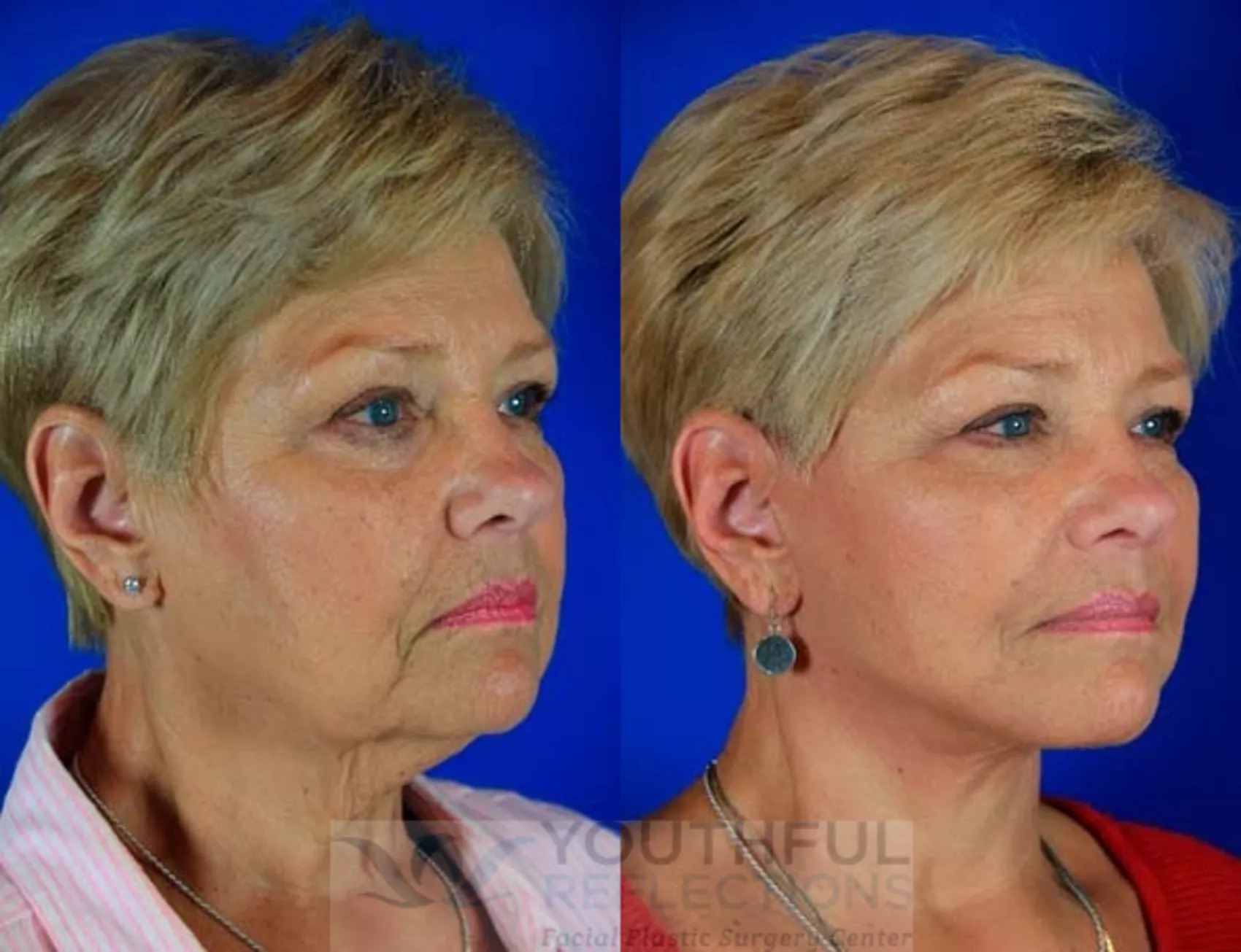 Level 3 Reflection Lift Before and After Photos