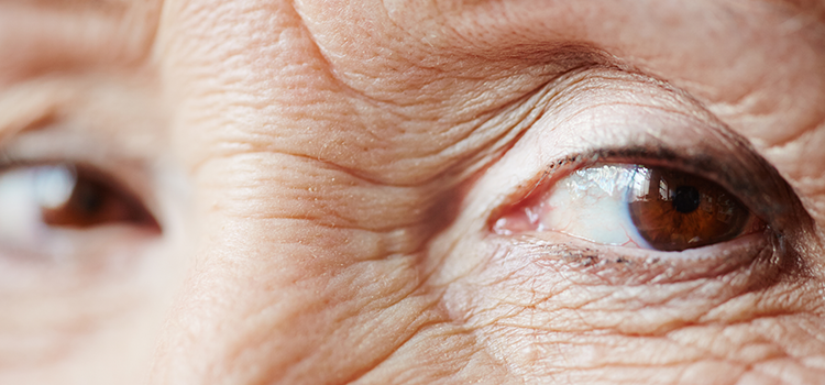 Extreme closeup of eyes with wrinkles and sagging eyelids