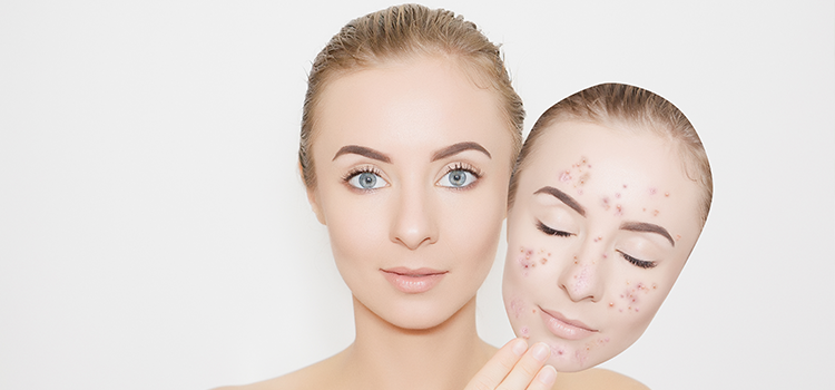 Acne Scar Treatment