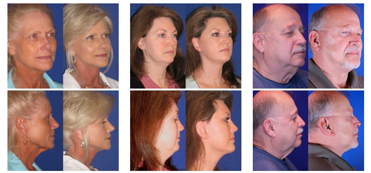 Collection of Reflection facelift before and after photos in Nashville