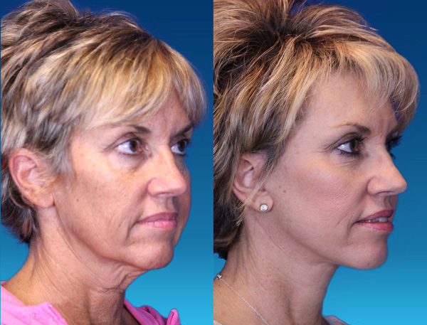 Angie Before and After