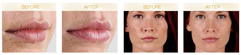 JUVEDERM® ULTRA XC before and after