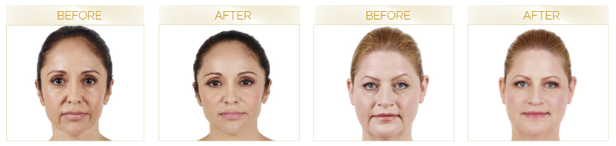 Juvederm XC before and after