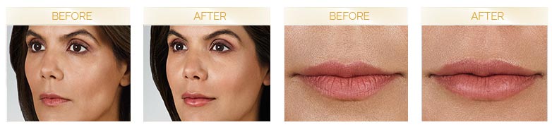 JUVÉDERM VOLBELLA® XC before and after