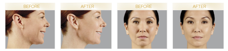 JUVEDERM VOLUMA® XC before and after