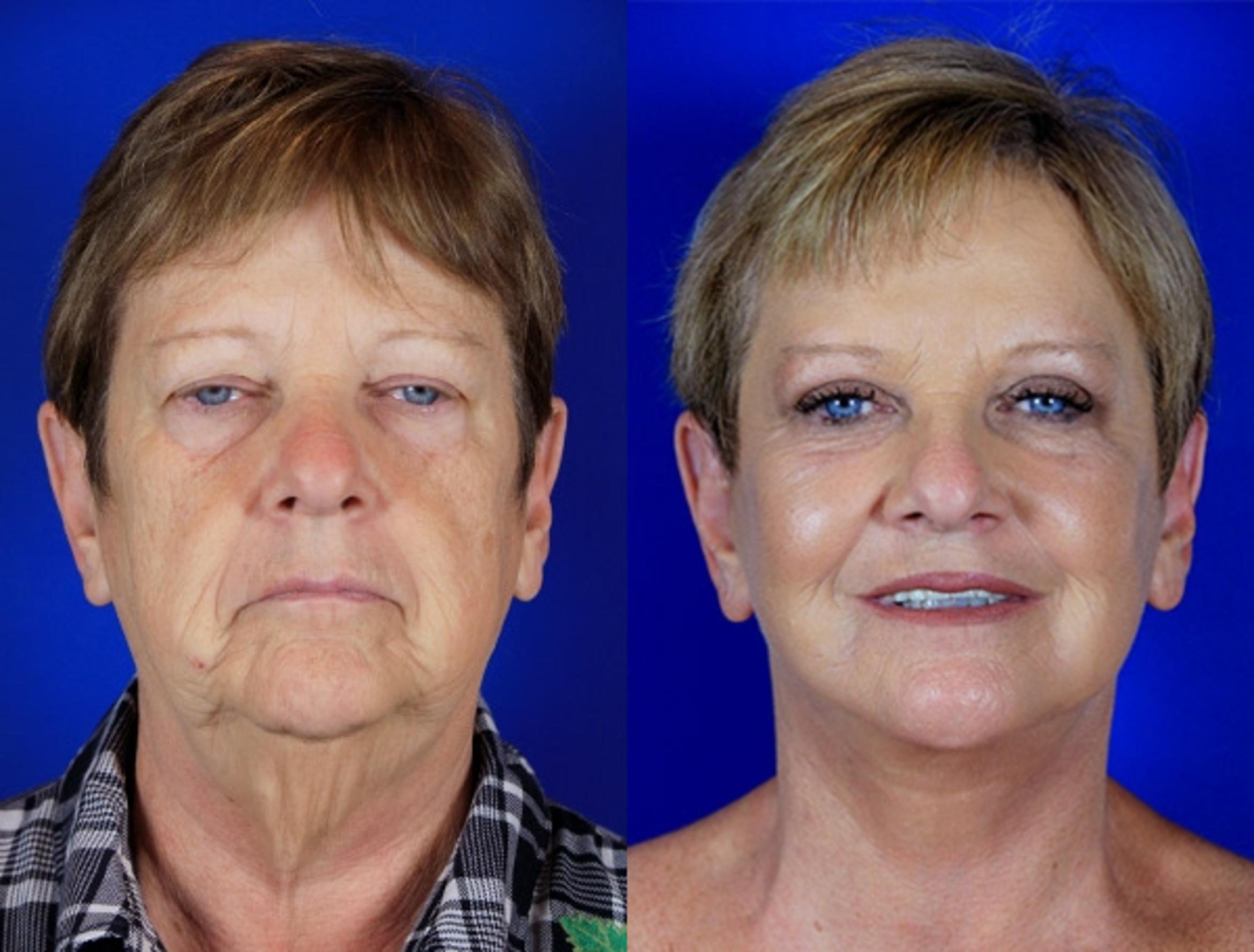 Woman before and after a brow lift, blepharoplasty, facelift, and laser skin resurfacing.