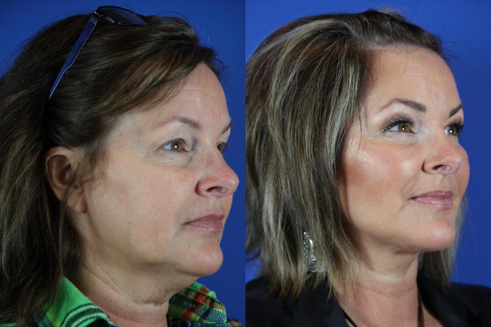 Susan Before and After Facelift