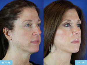 Laser Skin Resurfacing Before-and-After