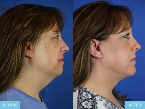 Chin Augmentation Surgery Before-and-After