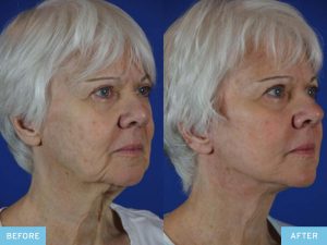Neck Lift Surgery Before-and-After