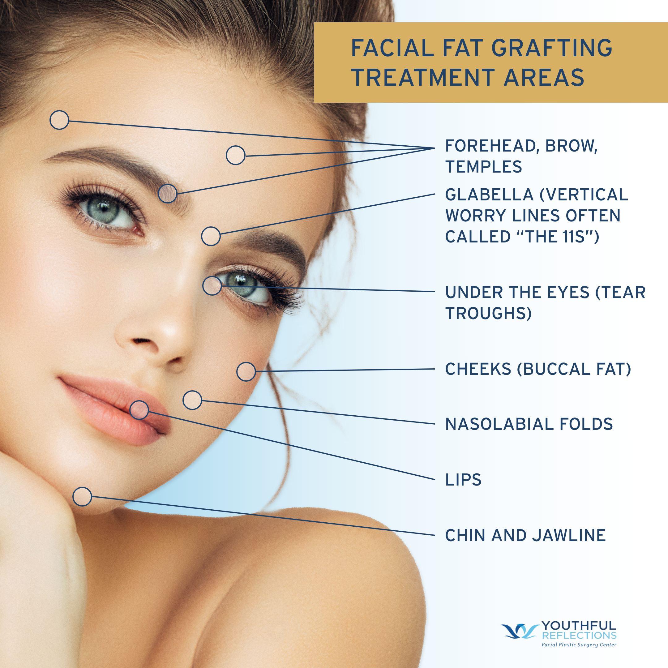 A diagram showing the treatment areas for facial fat grafting.