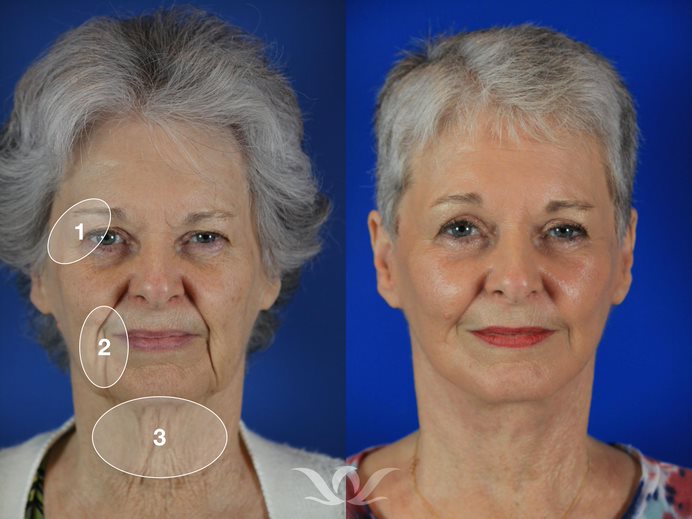 browpexy and upper blepharoplasty before and after
