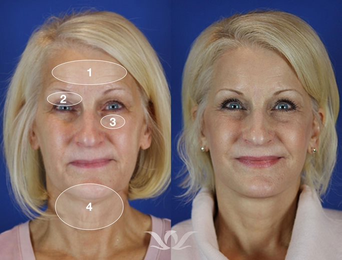 Level 3 Reflection Lift before and after that included a brow lift, upper eyelid surgery, and laser skin resurfacing
