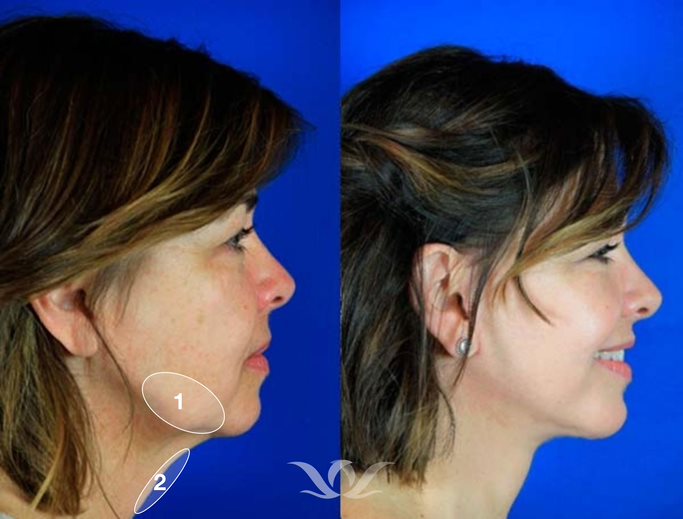 Level 3 Reflection Lift before and after that removed fat from the jowls and neck