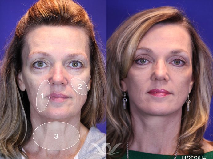 Reflection Lift before and after that included a neck lift and laser skin resurfacing