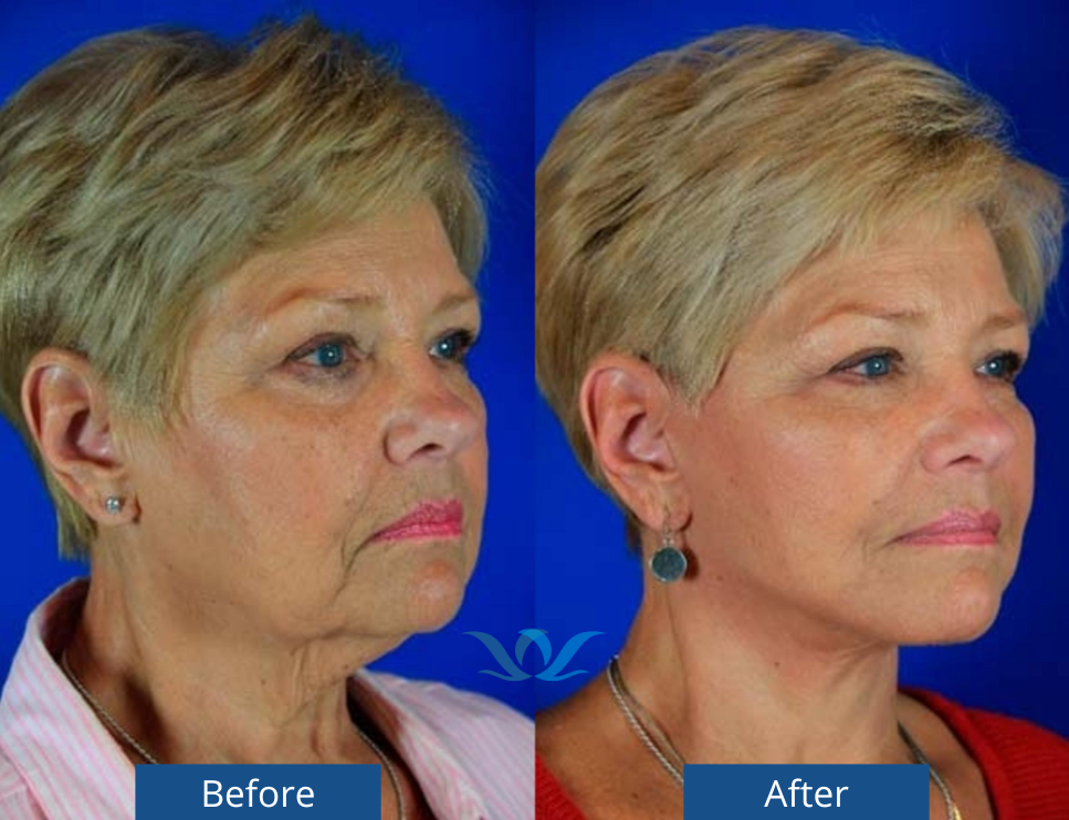 Real Dr. Boggess patient before and after facelift results 