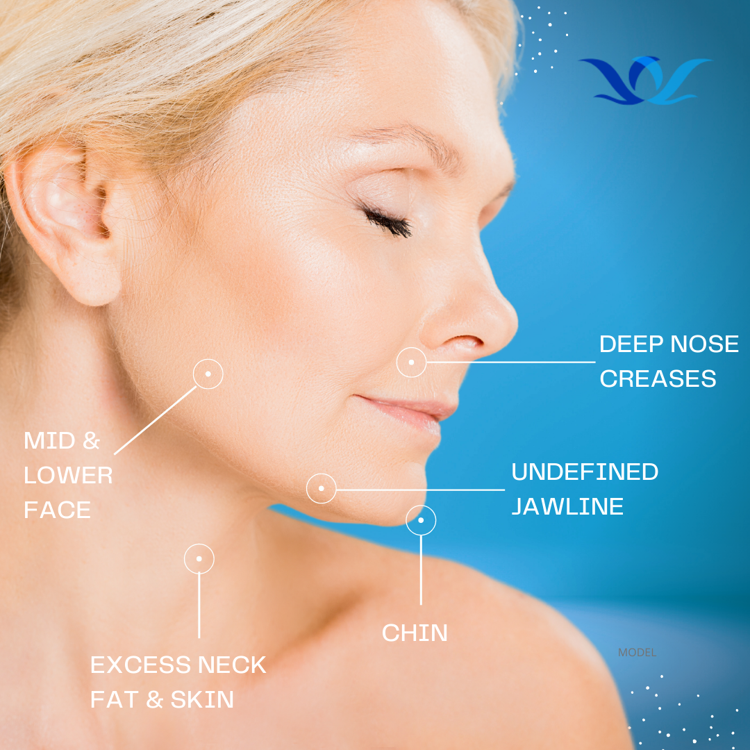 Facelift treatment areas outlined