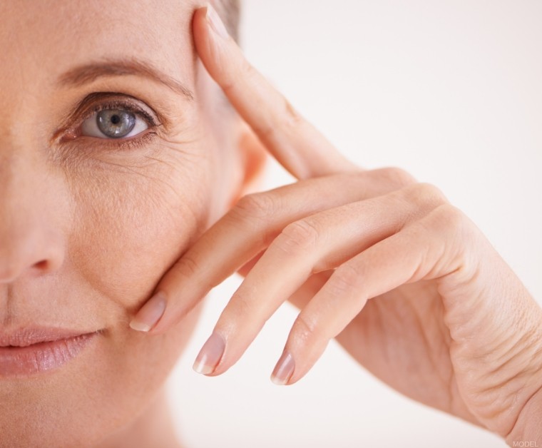 Woman with refreshed under-eye appearance after lower eyelid surgery (model)