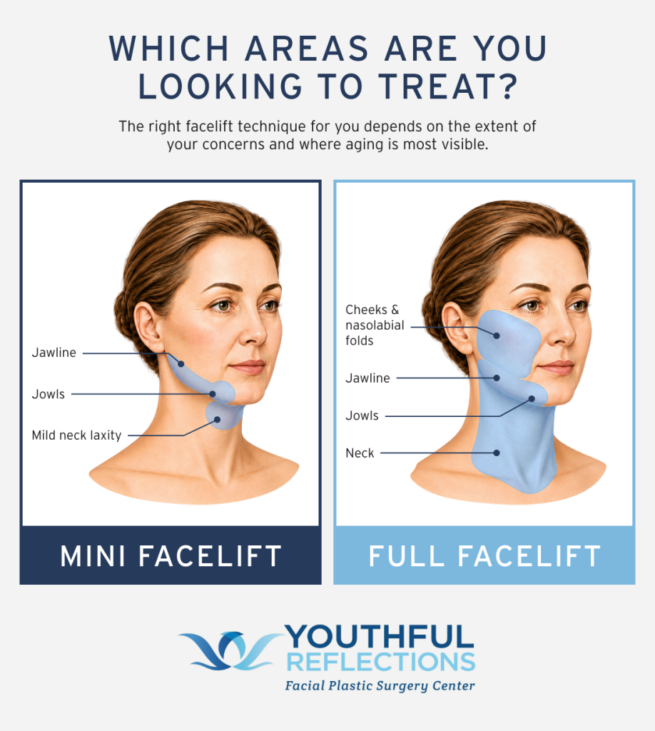 Side-by-side mini facelift vs. full facelift treatment area comparison illustration.